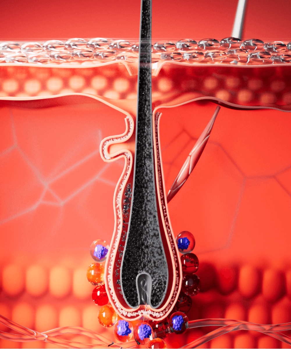 Superchouette- Illustration en coupe d'un follicule pileux sous la peau, entouré de petites bosses rouges et violettes enflammées, sur un fond rouge vif pour représenter l'irritation du cuir chevelu ou la folliculite.